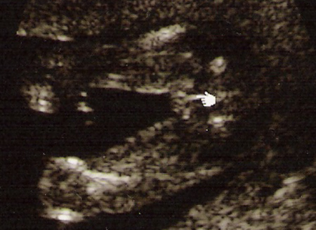 Kizimizin Kiz Oldugunun Anlasildigi Foto